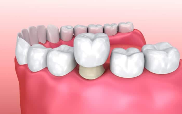 Dental Crowns in Lititz, Pennsylvania